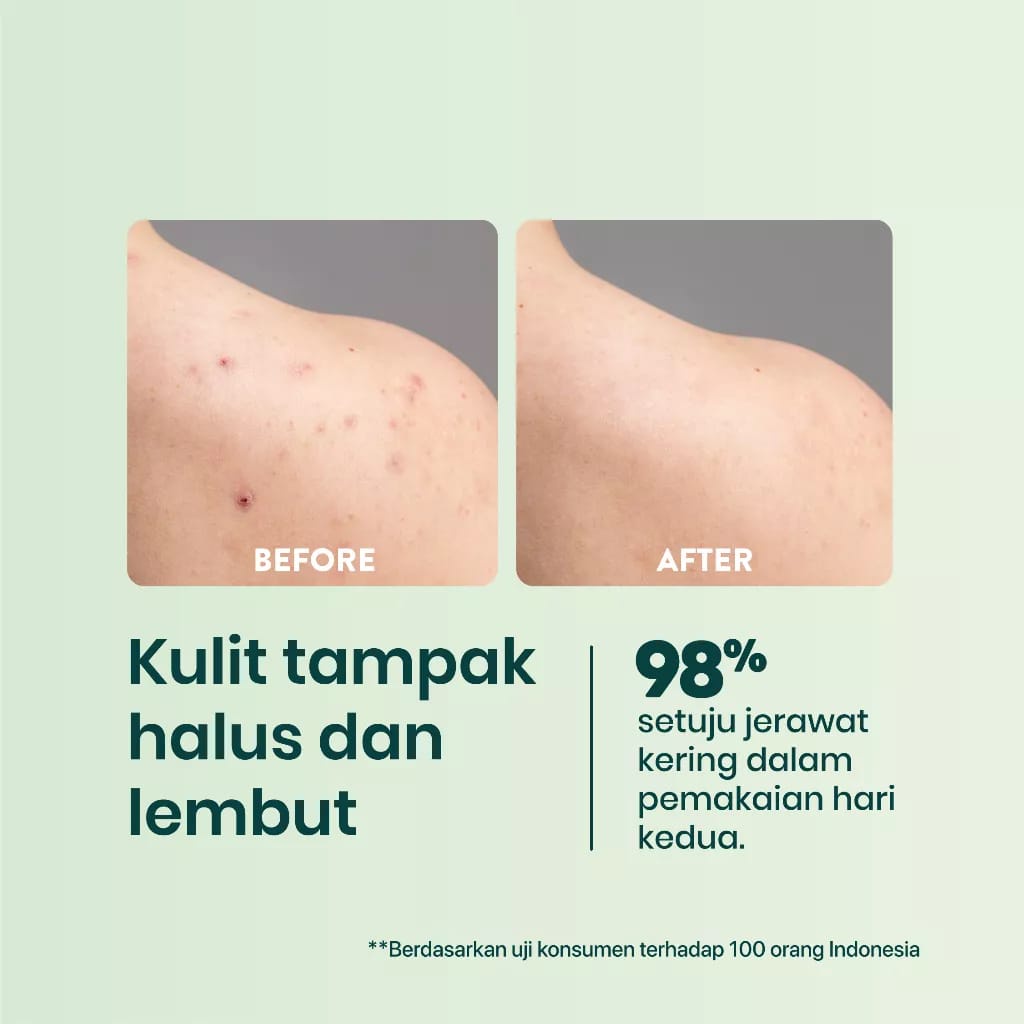 Npure Bacne Spray untuk Jerawat Punggung &amp; Badan