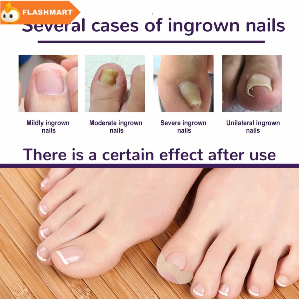 FLASHMART Stiker Korektor Kuku Kaki Adhesive Ingrown Toenail Patch 50 PCS - EH-50