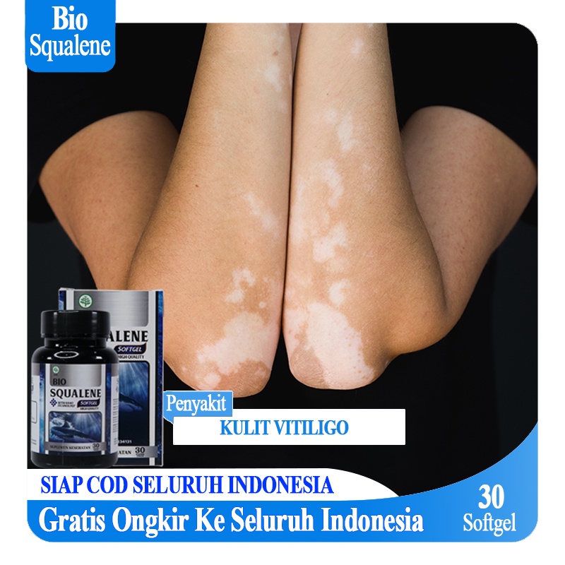 Obat Salep Vitiligo Bio Squalene Penyakit Kulit Putih Belang