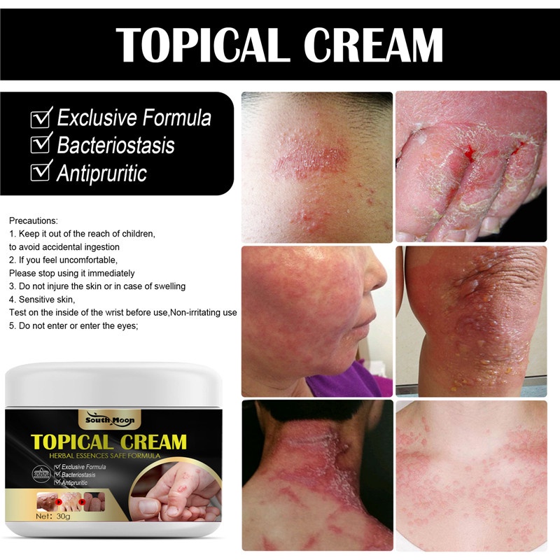 【COD】Lepuhan Keringat Anti-gatal Tangan dan Kaki Krim Topikal Psoriasis Krim Topikal Dermatitis Eczematoid Salep Eksim 30G