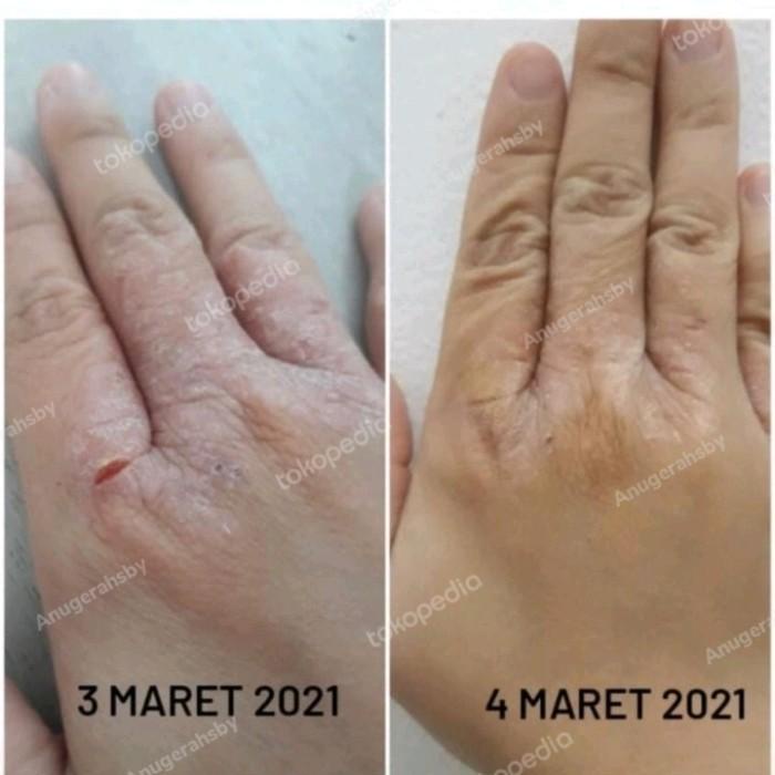 Aloe Propolis cream / mencegah bekas luka