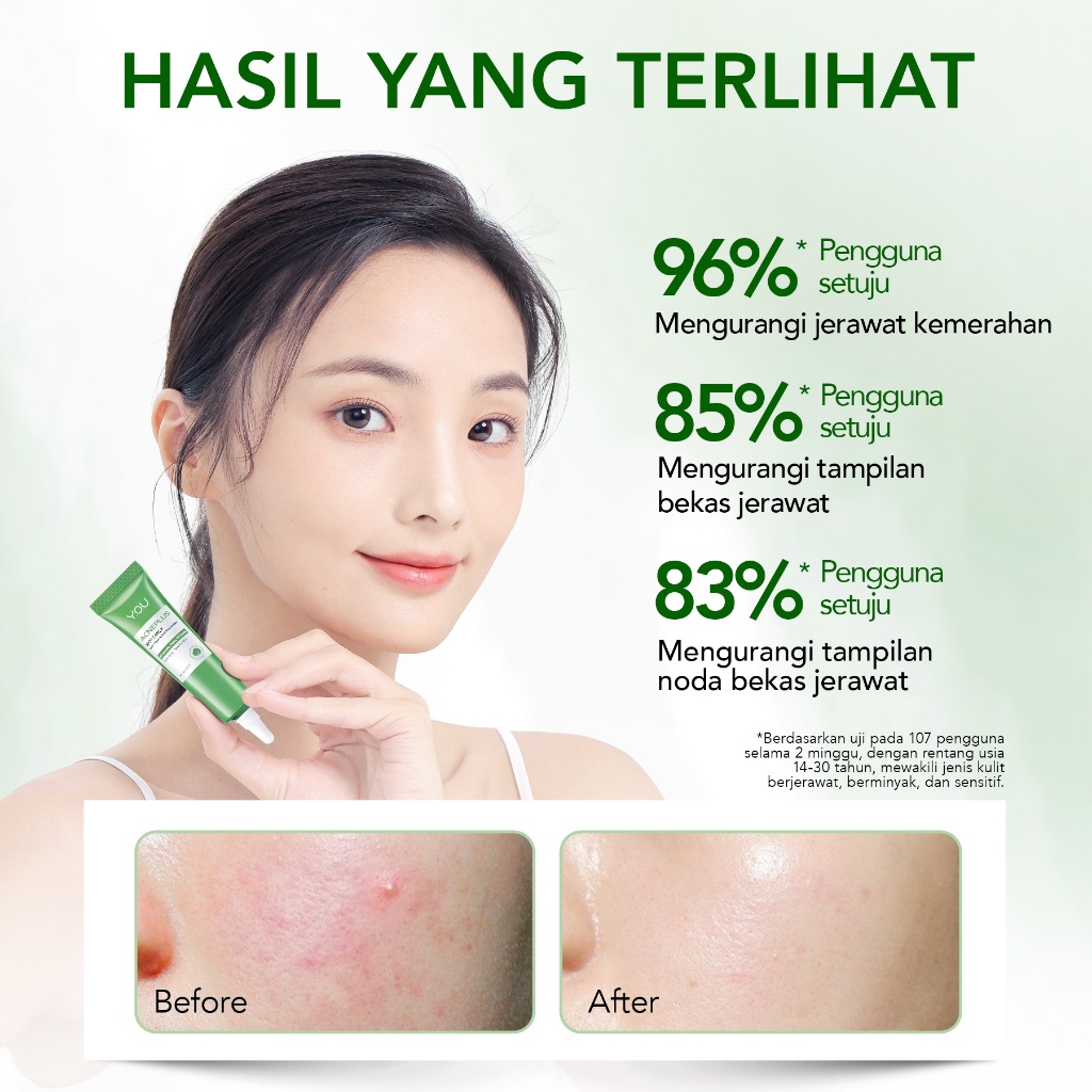 Y.O.U NEW FORMULA ACNE PLUS Action Spot Care 15gr Gentle Acne-Clearing Treatment Y.O.U OBAT TOTOL JERAWAT