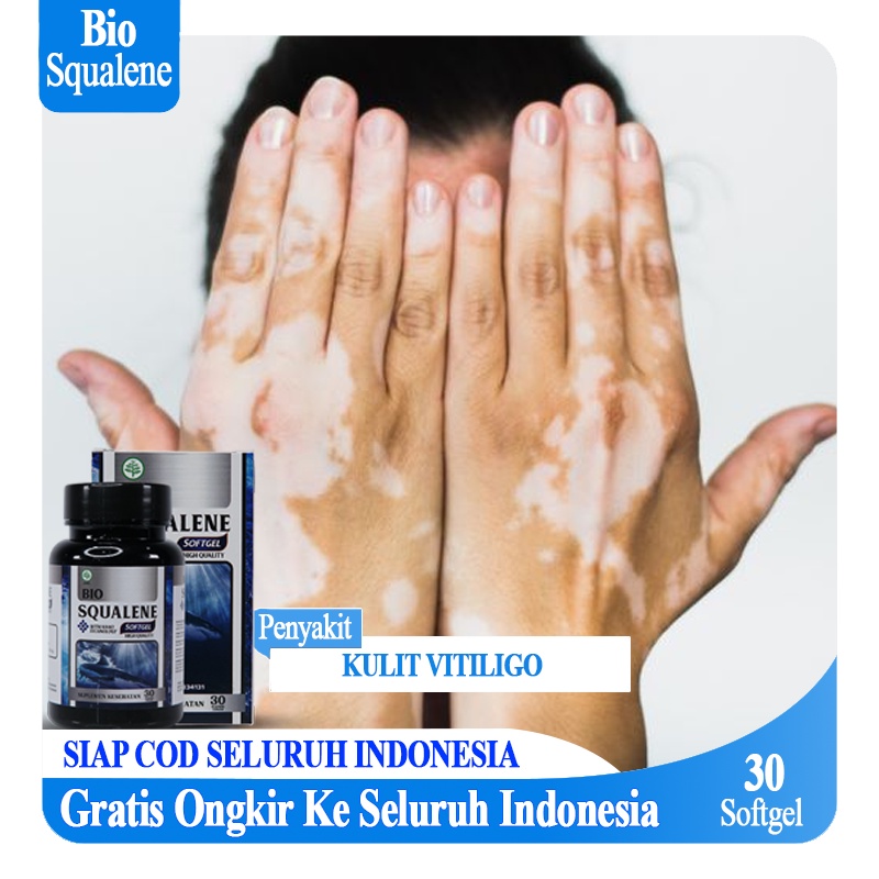 Bio Squalene Obat Vitiligo, Salep Vitiligo Obat Vitiligo