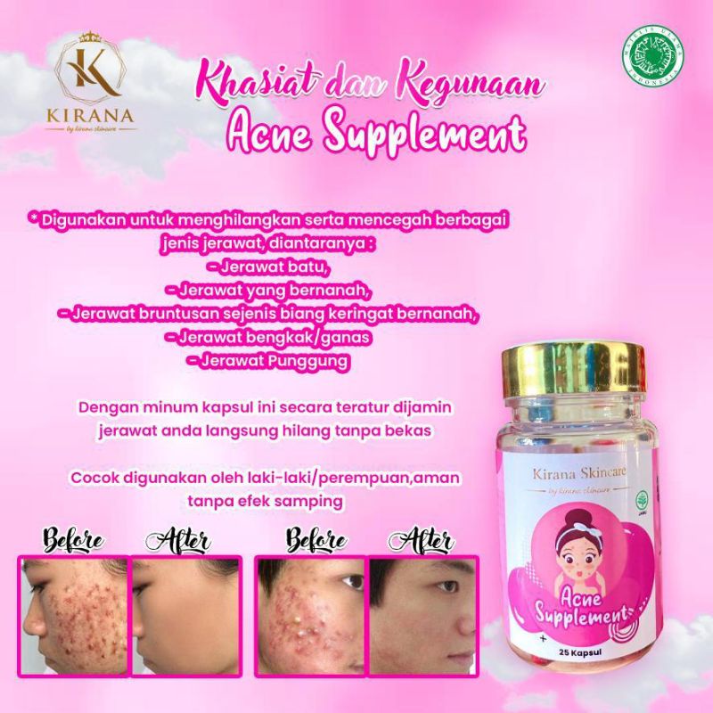 kapsul jerawat kirana skincare