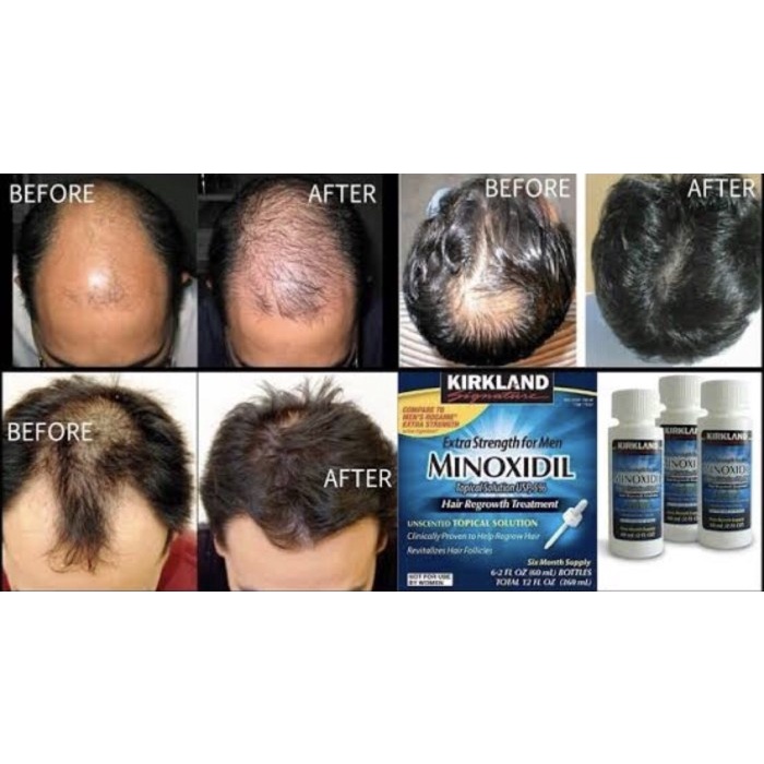 Kirkland - Minoxidil 5% ( 1 Kotak Isi 6 Botol)