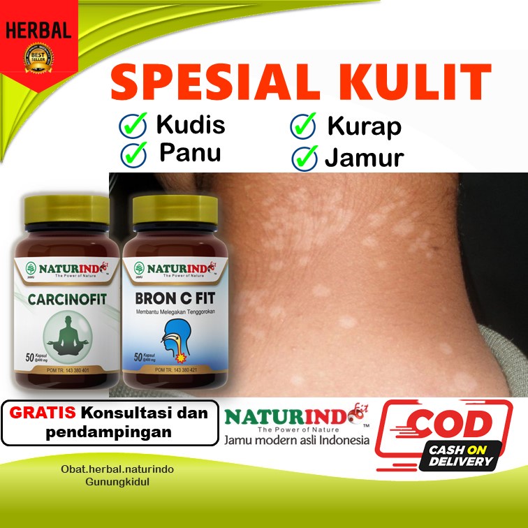 Obat Herbal Panu Wajah Exim Eksim Kering Menahun