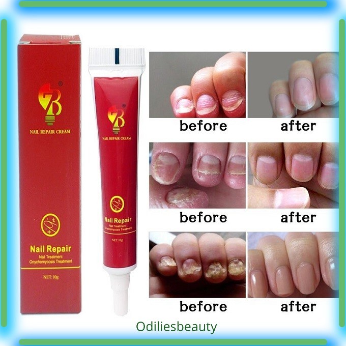 Terlaris Salep Anti Jamur Kuku Onikomikosis Paronychia Herbal Cina 20 Gr