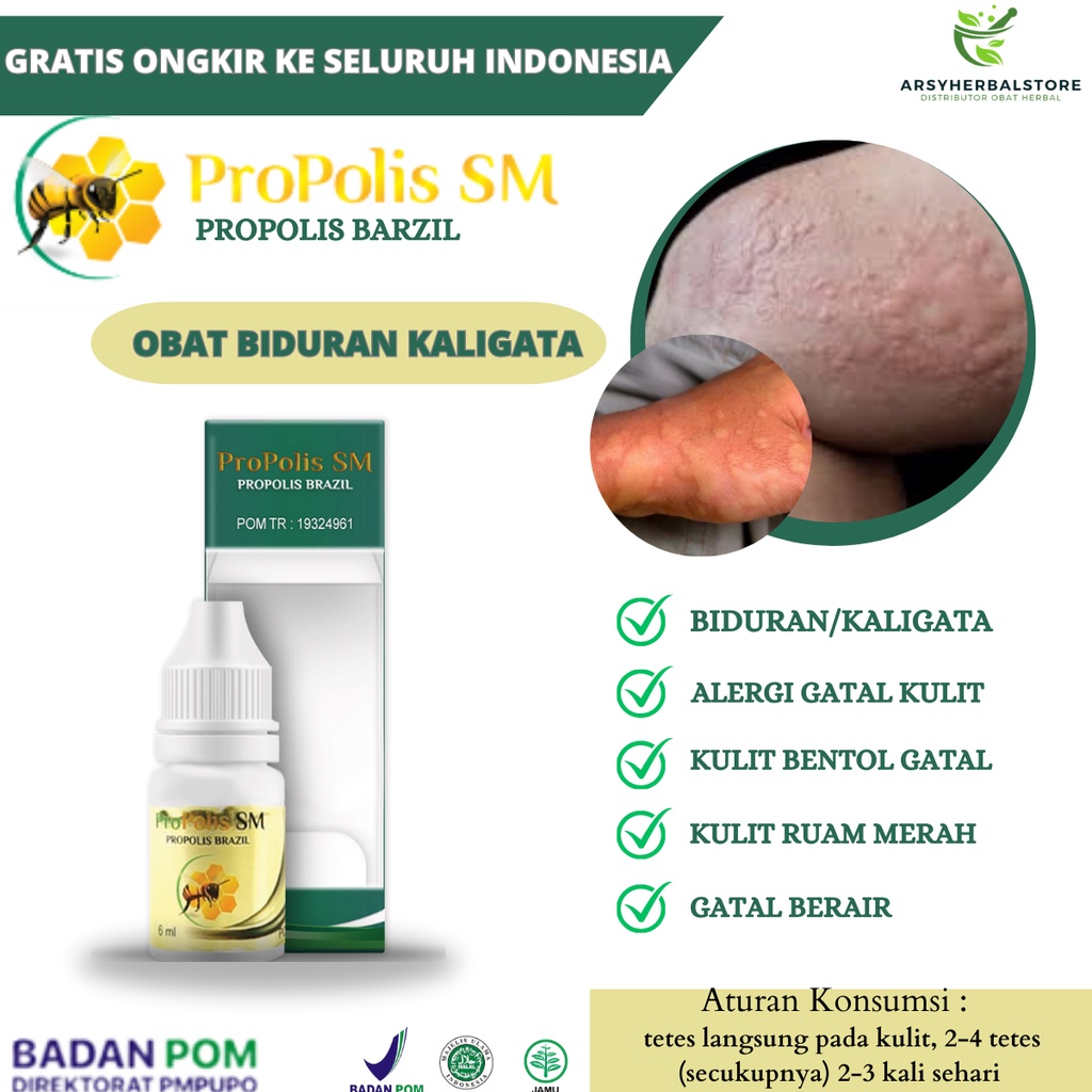 

Obat Bentol Seluruh Badan, Obat Biduran Kaligata, Alergi Cuaca, Alergi Makanan, Gatal Kulit, Alergi Dingin, Salep Biduran Kaligata, Kulit Gatal Seluruh Badan Dengan Propolis