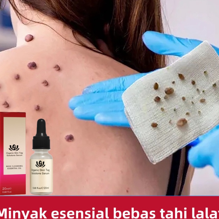 Stok Banyak Penghilang Tahi Lalat Penghilang Kutil Skin Tag Remover Flek Dan Bintik Menghilangkan Pi