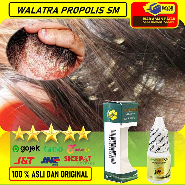 OBAT KETOMBE PARAH, KETOMBE BERKERAK, KETOMBE RAMBUT BASAH DAN KERING