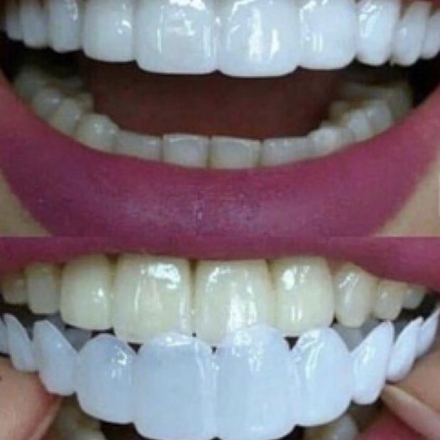 ideal smile gigi palsu atas bawah gigi palsu instan lepas pasang vener