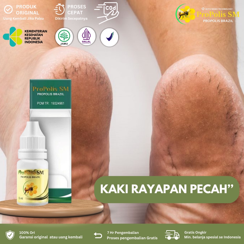 Obat Kaki Rayapan, Obat Kaki Kering dan Pecah-pecah Obat Penghilang Kaki Rayapan, Telapak Kaki Berlu