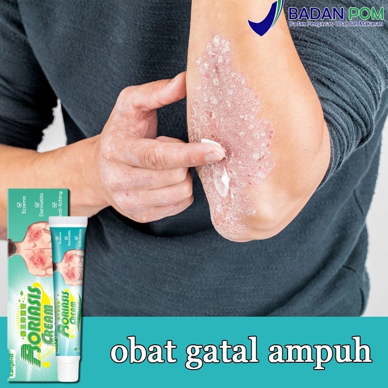 [READY] salep gatal psoriasis cream salep eksim salep gatal paling ampuh 20g Kulit Kepala Psoriasis