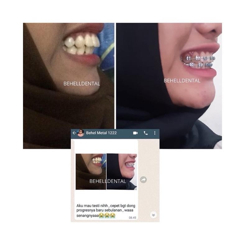 PLK BRACKET BEHEL GIGI METAL MINI ROTH 022 WITH HOOK 345 TOP SERIES BOX HIJAU / Kawat Dental Comfort