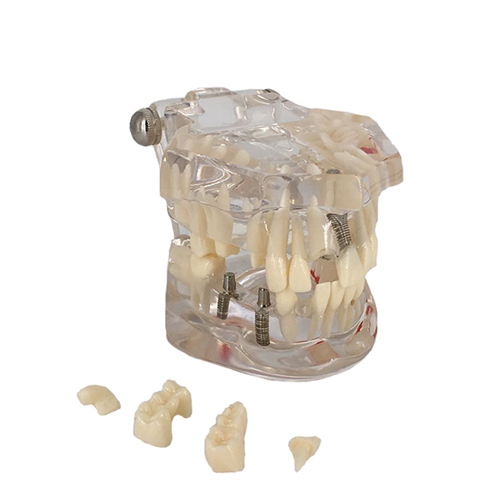 Model study gigi edukasi transparan studi implant phantom crown karies bridge bening impaksi model g