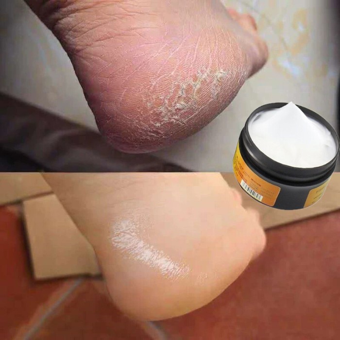 KRIM MINYAK KUDA, SALEP UNTUK KAKI BERI-BERI KRIM GATAL TERKELUPAS