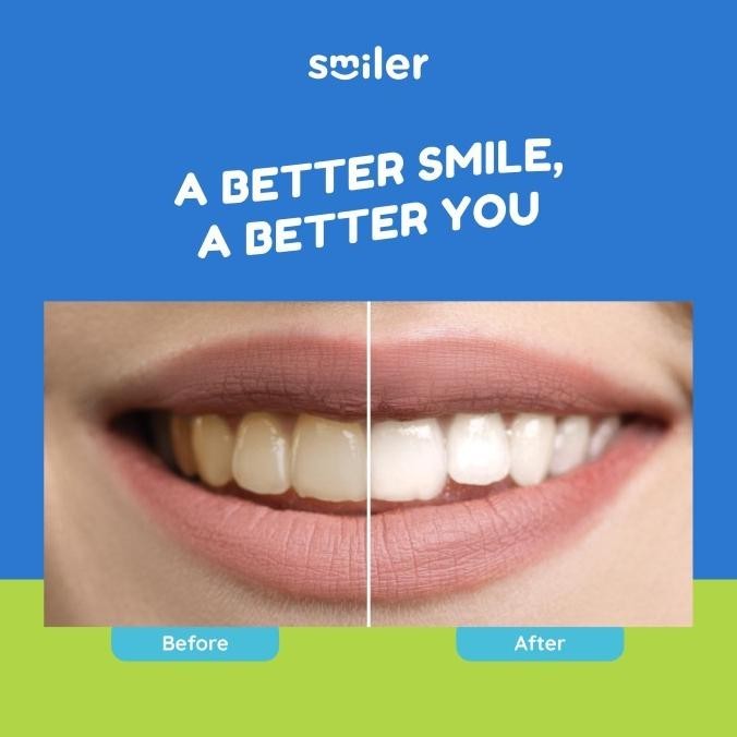 Teeth Whitening Kit - [#1 Teknologi Whitening Kit] - Kit Pemutih Gigi