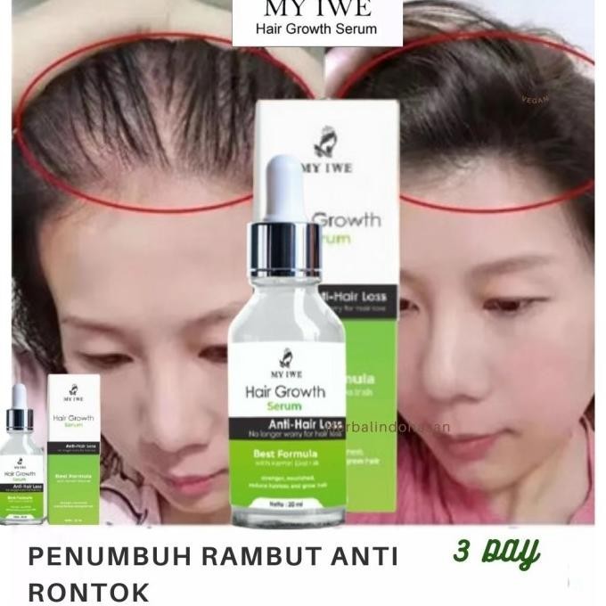 My Iwe Hair Growth Serum Penumbuh Rambut Anti Kebotakan