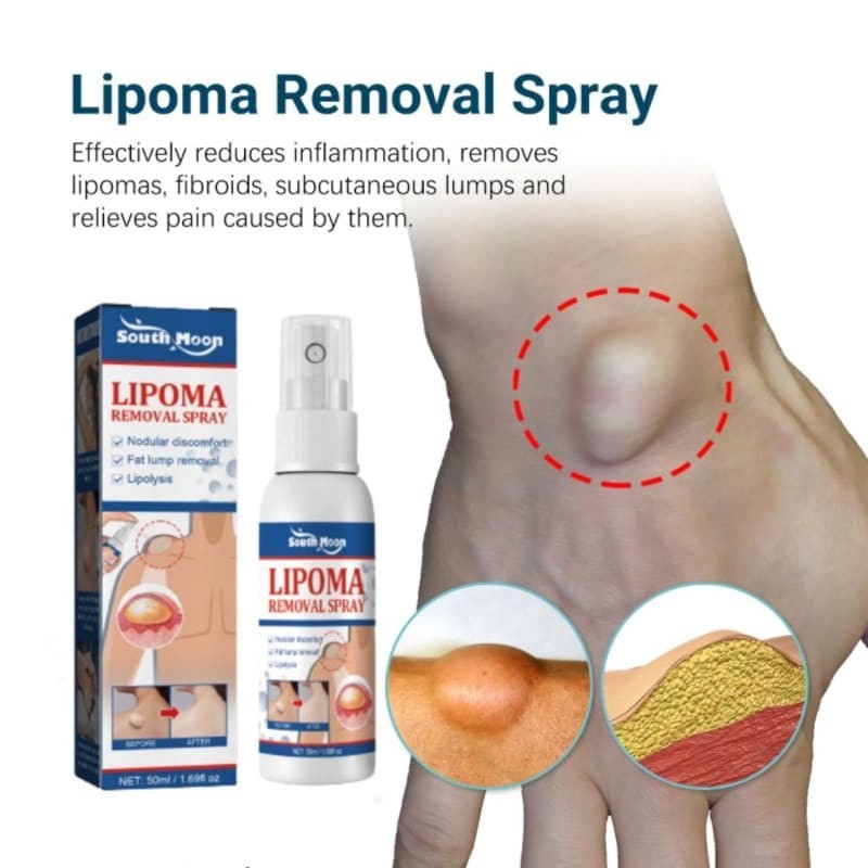 Benjolan Lipoma Removal Spray Penghancur Benjolan Lipoma Terlaris