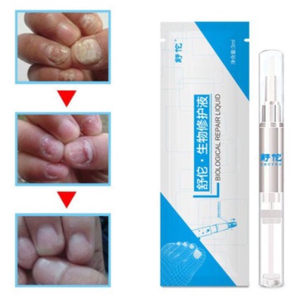 Murah AMPUH ATASI JAMUR KUKU KUTIL CANTENGAN  - Jamur Kuku Kaki Jamur kuku Tangan - Denok Stok Banya