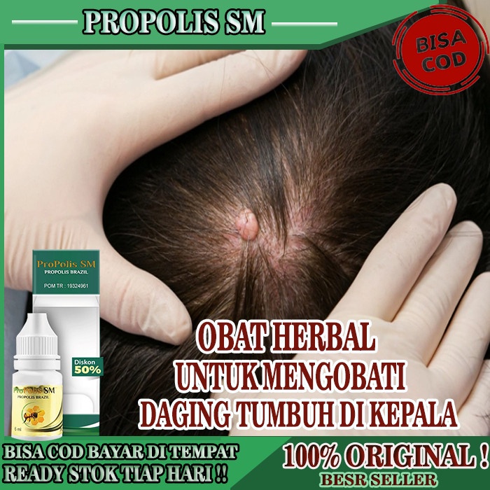 Promo Obat Daging Tumbuh Di Kulit Kepala, Obat Kutil Daging Jadi Di Kepala
