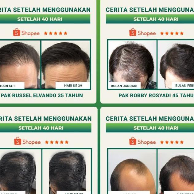 Newmo Serum Umbuh Rambut Cepat Aman Bpom Atasi Kebotakan