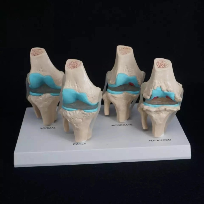 

Model Anatomi Anatomical Human Degenerative Knee Joint Disease Model