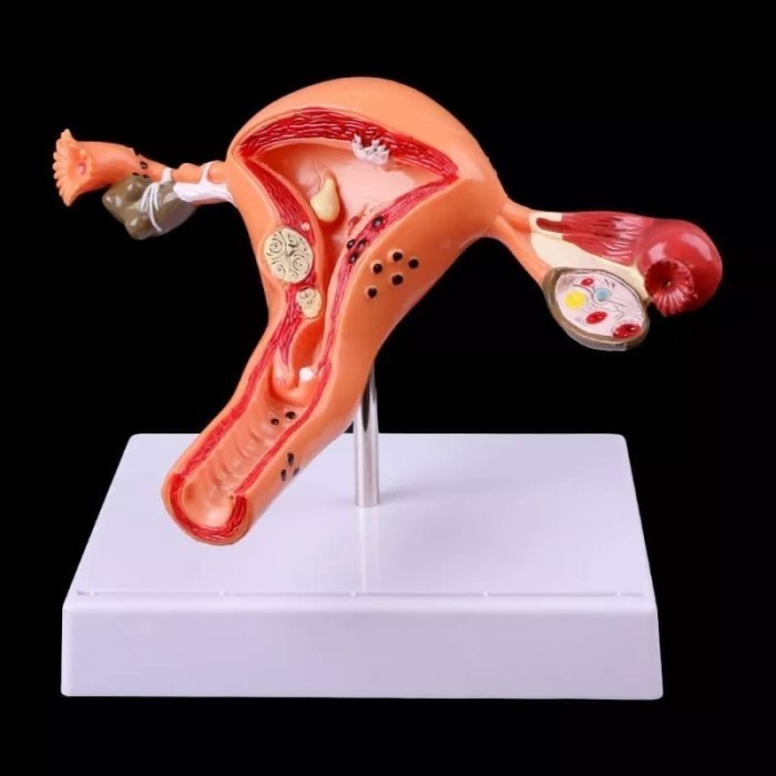 

Alat Peraga Model Anatomi Uterus And Ovaries Normal And Pathological