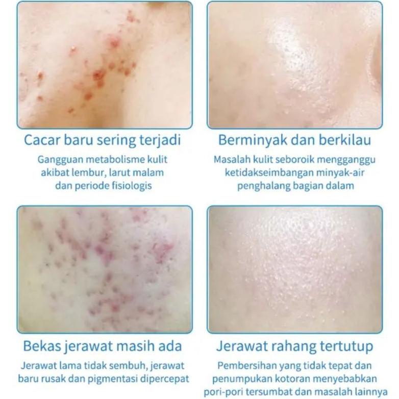 Hot Sale - IUALLURE GEL JERAWAT OBAT JERAWAT MERADANG KEMERAHAN ACNE SPOT