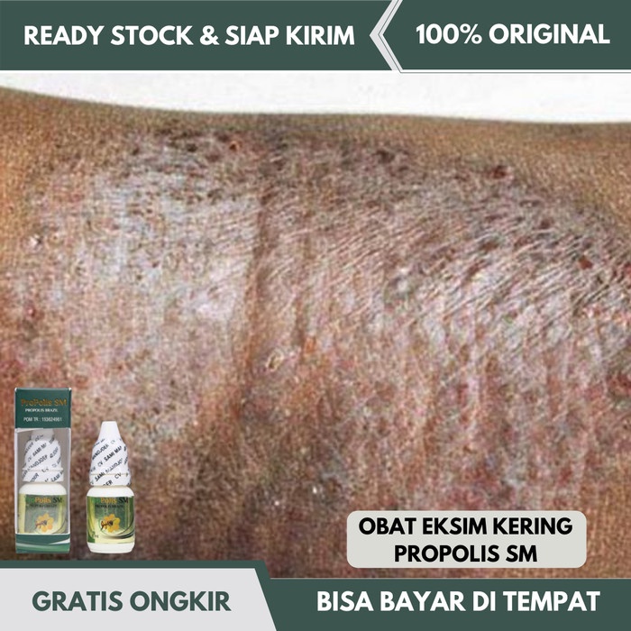 Promo Obat Eksim Kering Menahun, Gatal Kulit Salep, Menghilangkan Eksim Kaki