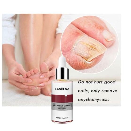 Recomend LANBENA Obat Jamur Kuku Perawatan Kesehatan Menghilangkan Jamur Kuku ~