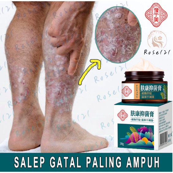 【100% Original】Salep gatal paling ampuh Obat psoriasis obat gatal salep kutil Obat Gatal Salep gatal