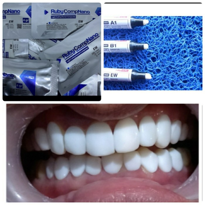 NEW COMPOSITE RUBY COMP NANO VENEER EW 4GR MADE IN TURKEY ORIGINAL TERBARU