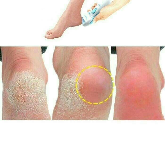 

Heles Hl833 - Penghilang Kapalan Pada Kaki Dan Hl-833