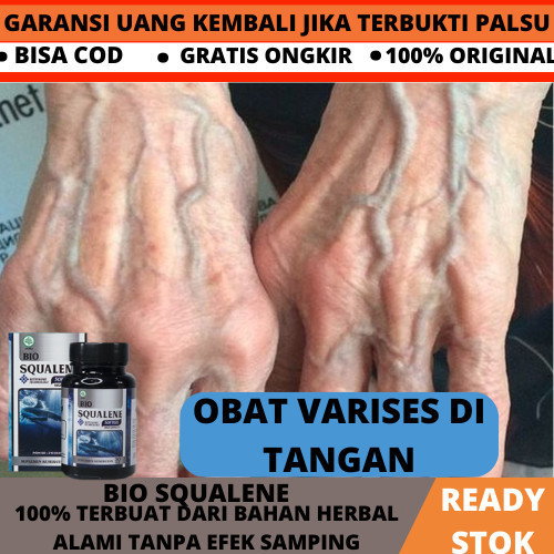 Obat Varises Di Tangan, Obat Varises, Obat Penghilang Urat Menonjol