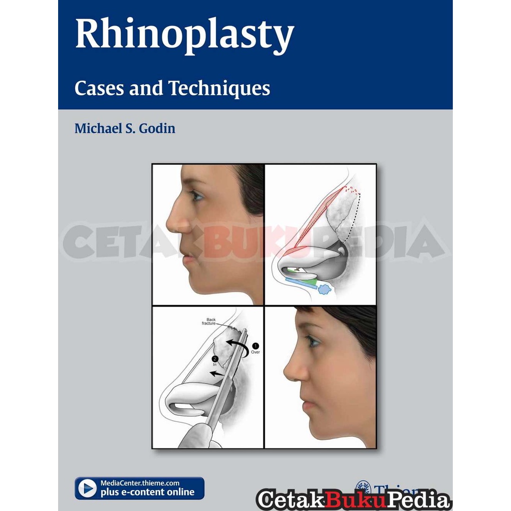 Rhinoplasty Cases Techniques