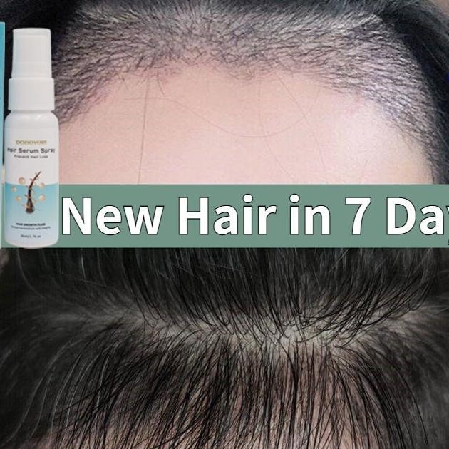 [Bpom] Dodoyuri Serum Umbuh Rambut Umbuh Rambut Botak Obat Umbuh Rambut 30Ml Umbuh Rambut Cepat Kont