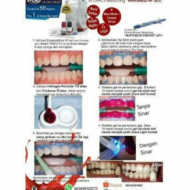 Whiteness HP red FGM merah bleaching pemutih gigi teeth whitening