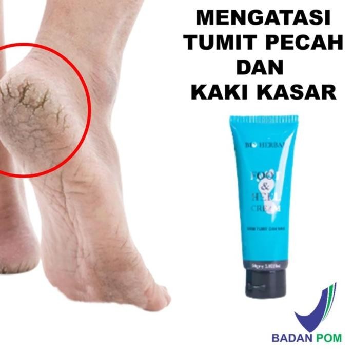 Obat Kaki Pecah2 dan Kering Parah BPOM Krim Kaki Gatal Cream Tumit