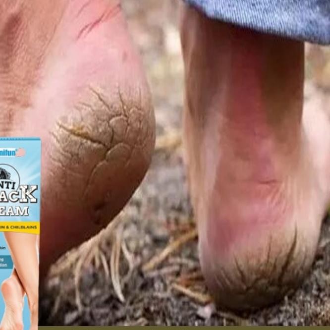 Krim Kaki Pecah Dan Kering P Kaki Pecah Dan Kering Ampuh Perawatan Kaki Pecah Dan Kering 20G Tut Kak