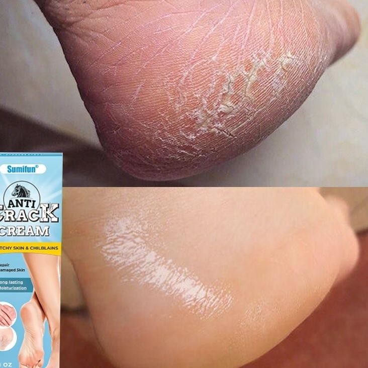 Krim Kaki Pecah Dan Kering P Kaki Pecah Dan Kering Ampuh Perawatan Kaki Pecah Dan Kering 20G Tut Kak