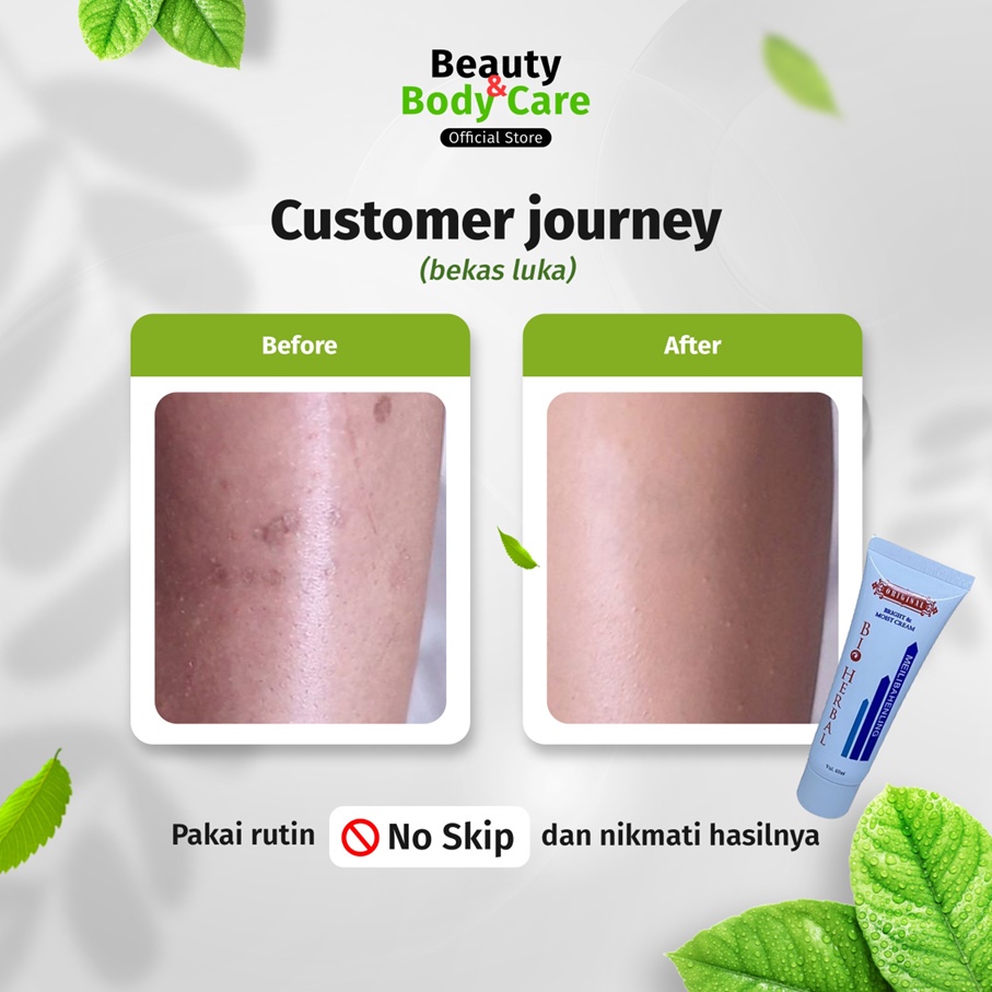 Ghilang Luka Hitam Koreng Di Kaki Wajah Luka Bakar Lama Obat Krim P Salap Ghilang Menghilangkan Luka