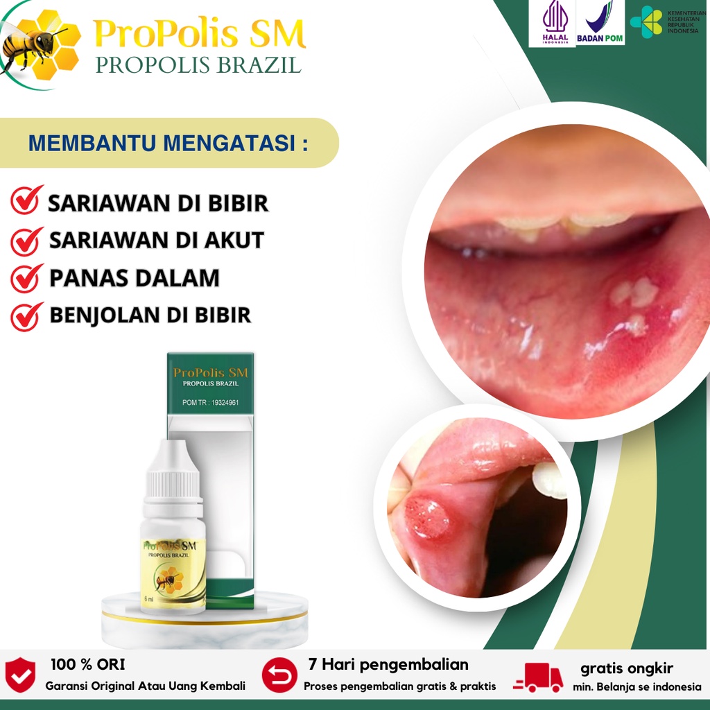 Obat Sariawan, Obat Sariawan Akut, Obat Sariawan Meradang, Obat Sariawan Susah Sembuh, Obat Sariawan