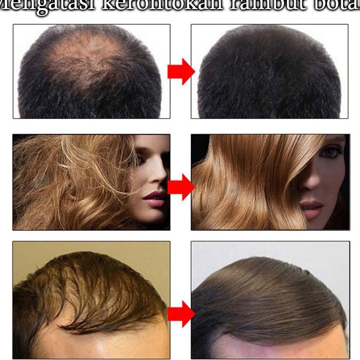Umbuh Rambut Hair Growth Serum Umbuh Rambut Botak Serum Umbuh Rambut 20Ml Serum Rambut Rontok Umbuh 