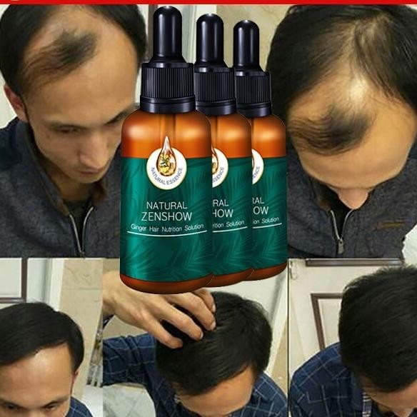 Cairan Umbuh Rambut Umbuh Rambut Cepat Dan Tebal/Umbuh Rambut Cepat/Umbuh Rambut Botak Pria/Umbuh Ra