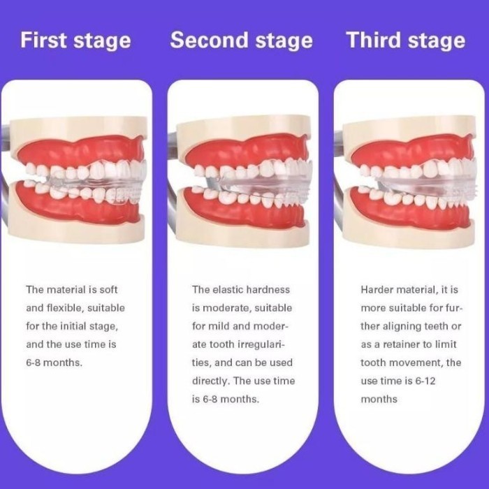 Terlaris Aligner Gigi Perapih Gigi 1 Set Teeth Aligner SALE