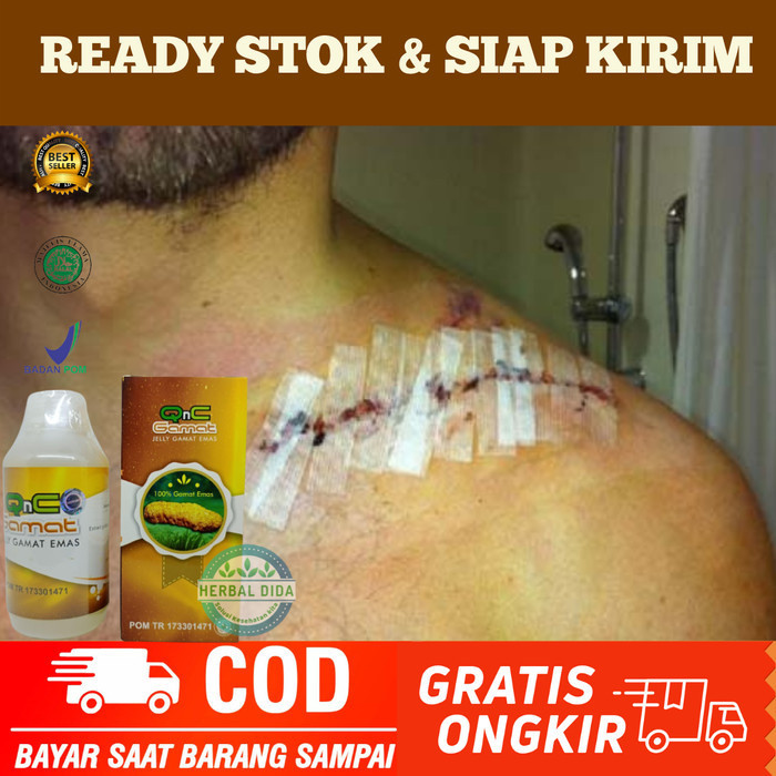 Obat Herbal Retak Tulang Selangka, Obat Patah Tulang Selangka