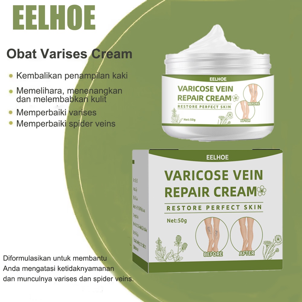 Efektif Permanen Krim Varises Cream Varises Angiitis P Flebitis Kaki Krim Varises Obat Varises P