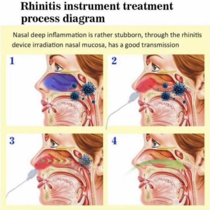 bionase alat terapi hidung sinusitis pilek alregi Rhinitis Erin MI