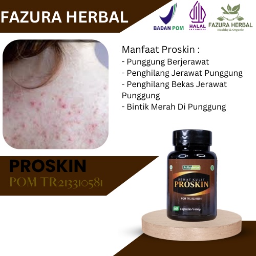 Proskin - Obat Jerawat Punggung, Obat Jerawat Memenuhi Punggung, Obat Penghilang Jerawat Punggung, O